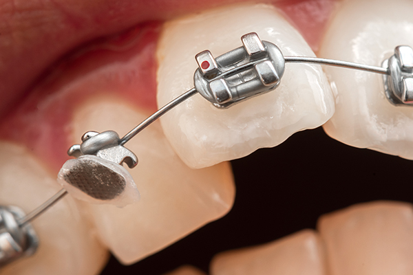 Orthodontic Emergencies in Riverside CT